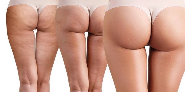 VelaShape Smooth