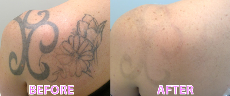 Laser Tattoo Removal Before After