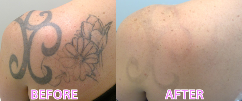 Proper Aftercare Instructions for Laser Tattoo Removal  Rochester Tattoo  Removal