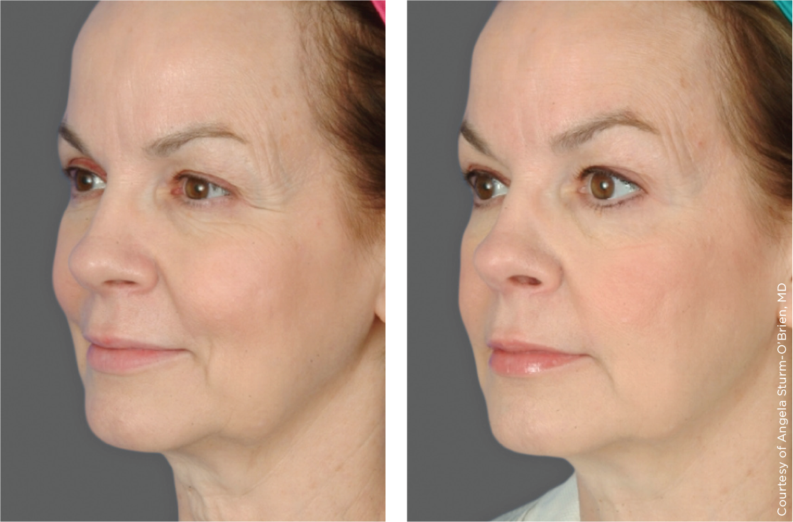 Ultherapy Before After - Restobod Calgary