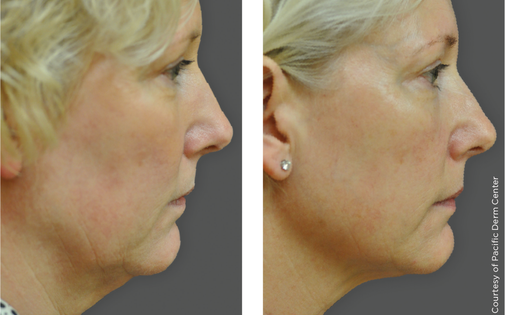 Ultherapy Before After - Restobod Calgary